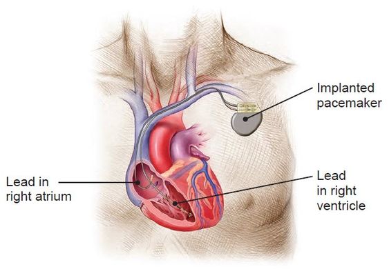 Pacemaker Implantation: Procedure and Care